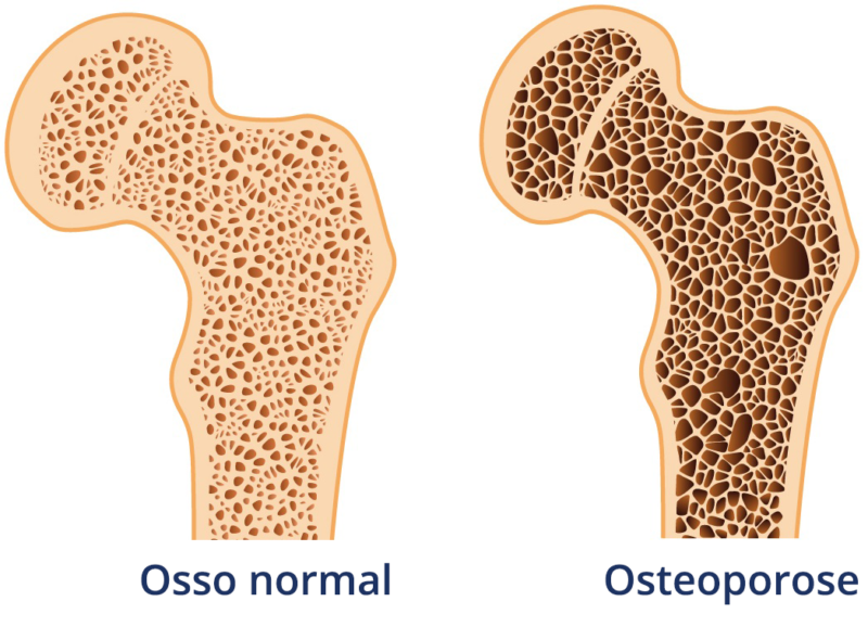 Por que ultimamente temos ouvido falar mais da osteoporose? Ela está aumentando em frequência?